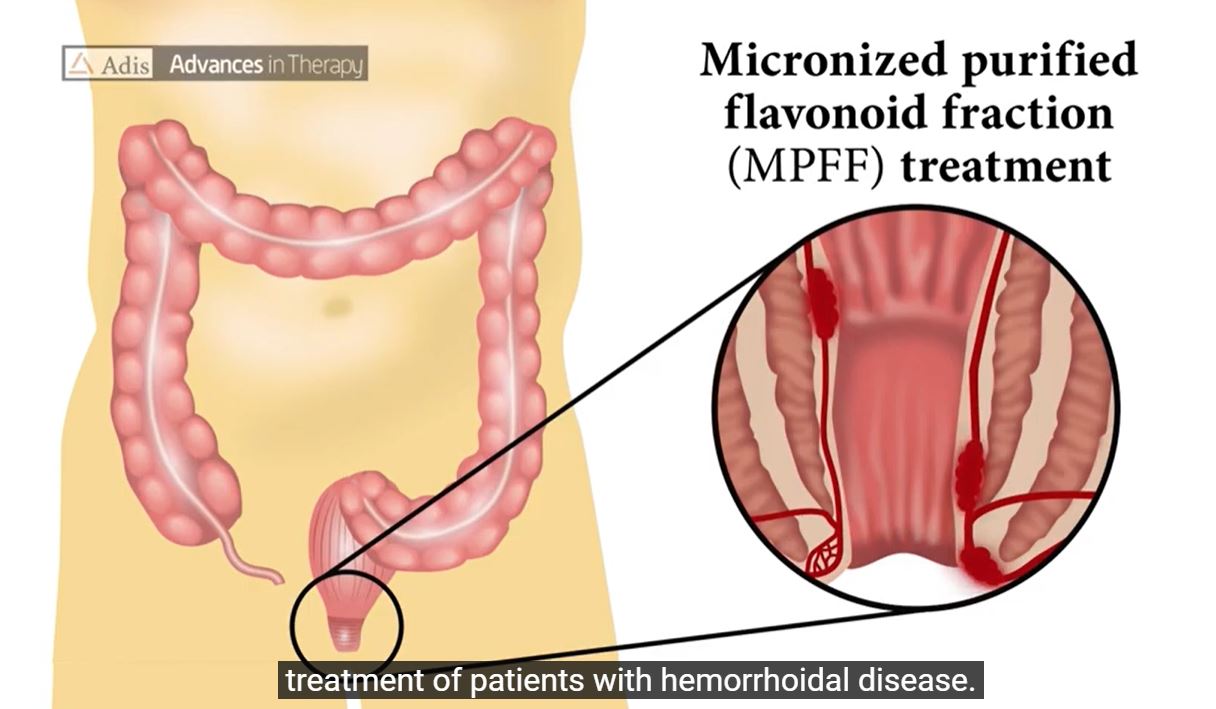 Micronized purified flavonoid fraction in hemorrhoid disease: a systematic review and meta-analysis